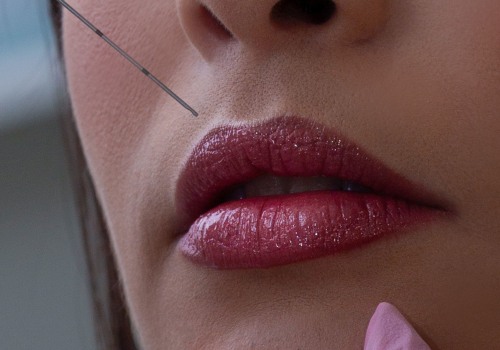 Lip Augmentation in Zürich, Switzerland: Confidence Beyond Chiropractic Occupational Health